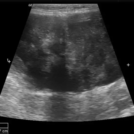 Ultrasound Thigh